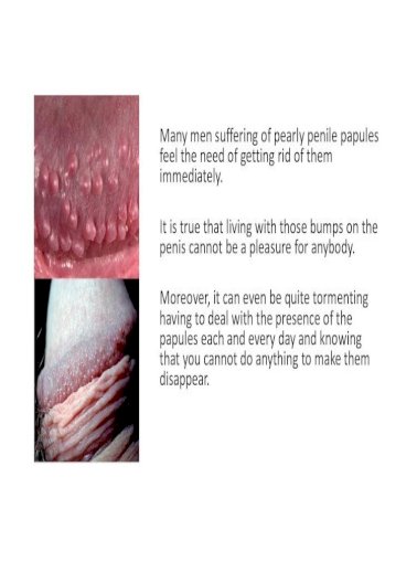 Pearly penile papules laser removal